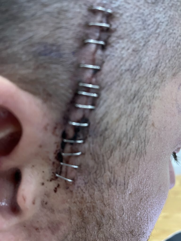 stitches in head